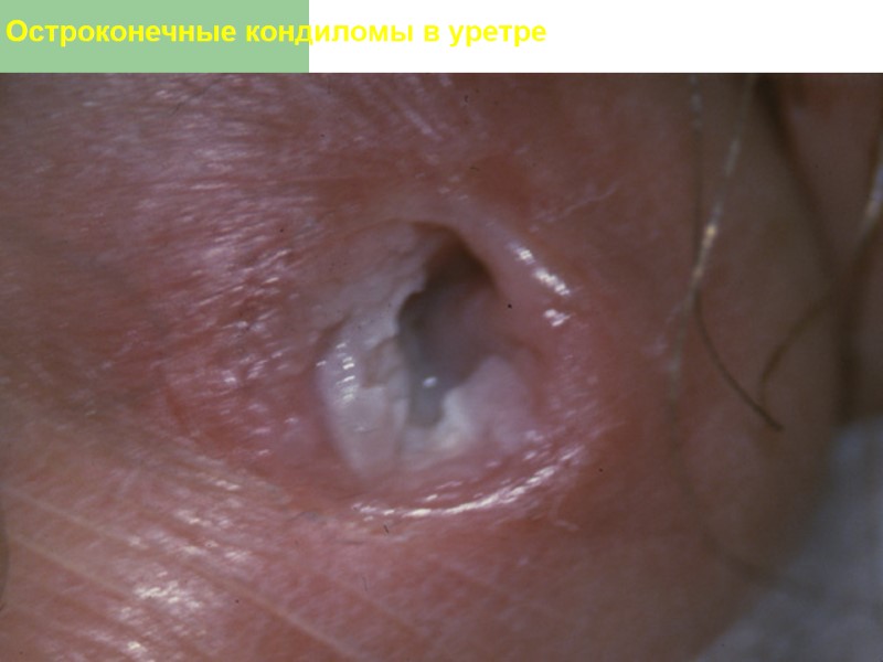 Остроконечные кондиломы в уретре